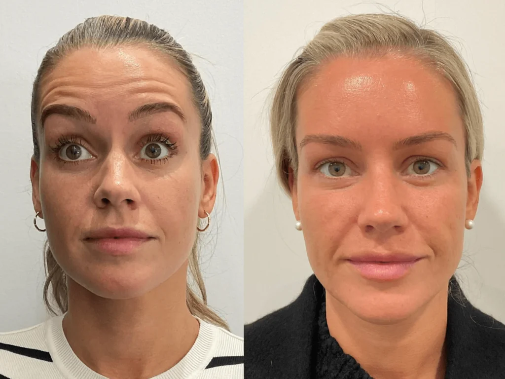 Botox Treatment in Gurugram