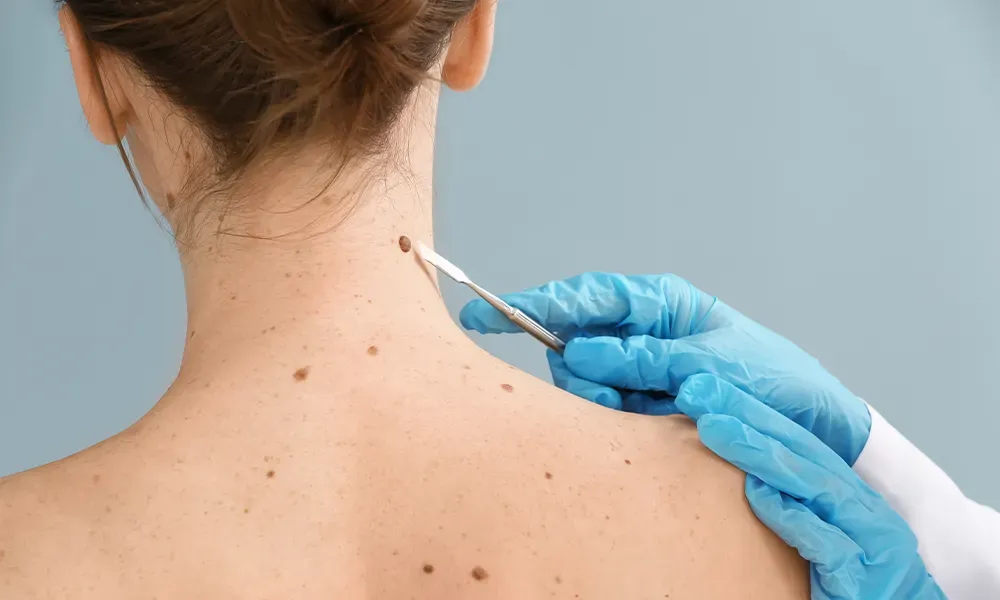 Skin Tags & Warts Removal in Gurugram