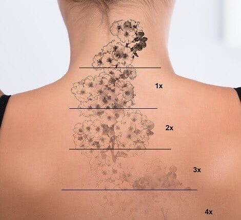 Tattoo Removal in Gurugram