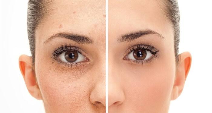 Fractional CO2 Laser Treatment in Gurugram