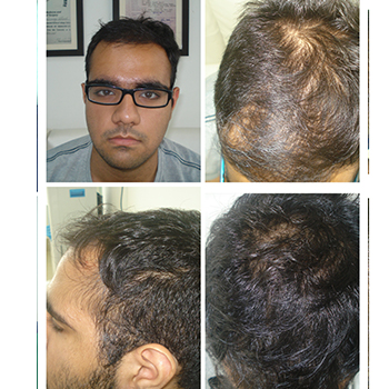 Before/After PRP Hair Treatment Results