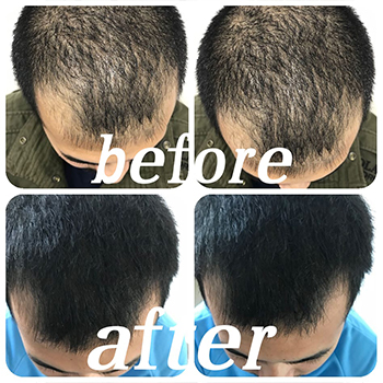 Before/After PRP Hair Therapy Results