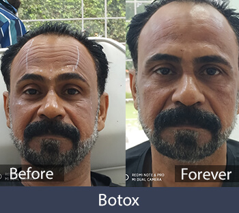 Botox Treatment Before/After Result