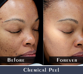 Before/After Chemical Peeling Results