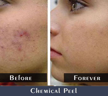 Before/After Acne Treatment Results