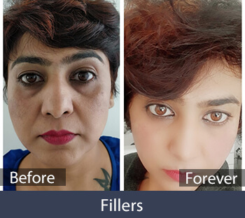 Filler Treatment Before/After Result