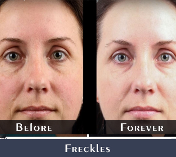 Before/After Freckles Treatment Results
