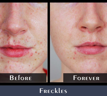 Before/After Freckles Removal Results