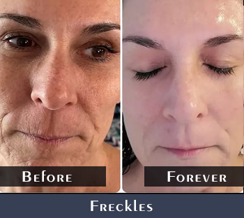 Freckles Treatment Results