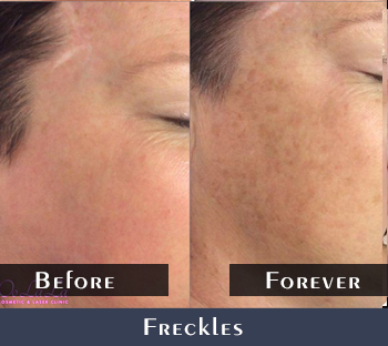 Freckles Removal Results