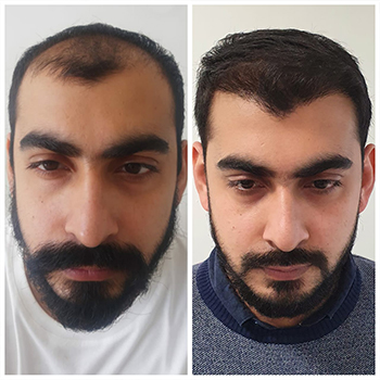 Before/After Hair Treatment Result Image