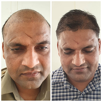 Before/After Hair Loss Treatment Results Image 