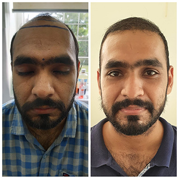 Before/After Hair Loss Results Image