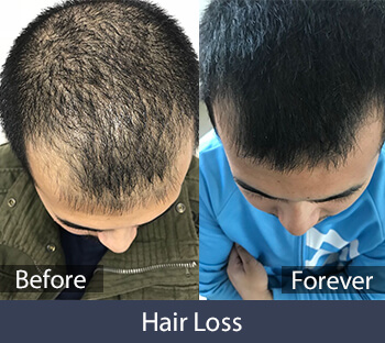 Hair Loss Treatment Before/After Result