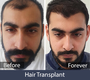 Hair Transplant Before/After Result
