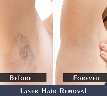Best Laser Hair Removal in Gurgaon, Laser hair treatment