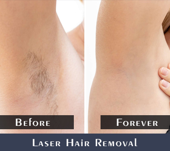 Before/After Hair Removal Treatment Results