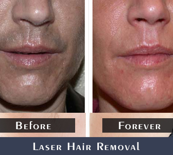 Before/After Laser Hair Removal Treatment Results