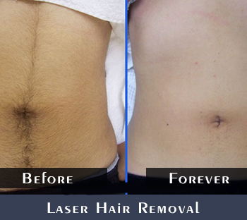 Before/After Laser Hair Removal Results