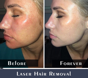Before/After Laser Hair Reduction Treatment Results