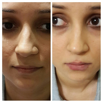 Before/After Skin Rejuvenation Treatment Results