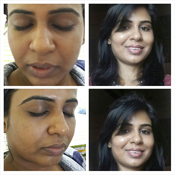 Before/After Wrinkles Treatmenr Results
