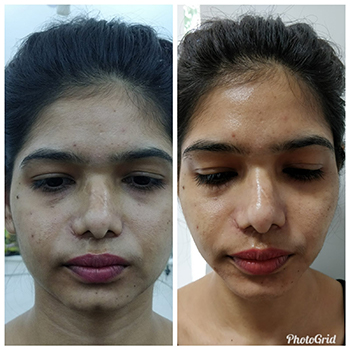 Before/After Uneven Skin Texture Treatment Results