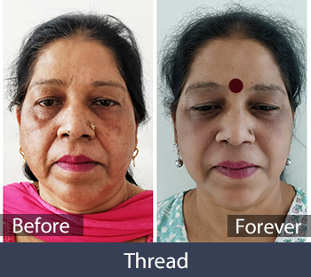 Thread Treatment Before/After Result