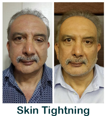Before/After Skin Tightening Results