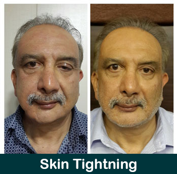 Before/After Loose Skin Treatment Results Image