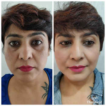 Before/After Skin tightening Result Image