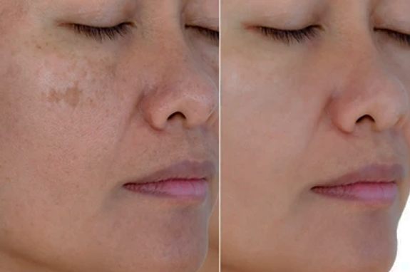 Freckles Treatment In Gurgaon