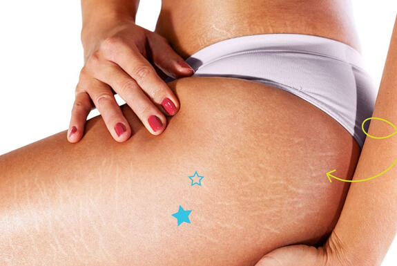 Stretch Marks Removal in Gurgaon