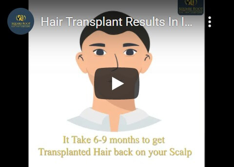 Hair Transplant Result Video