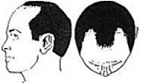 Grade 4 Baldness Icon Image