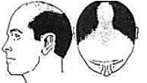 Grade 5 Baldness Icon Image