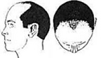 Grade 3 Baldness Icon Image