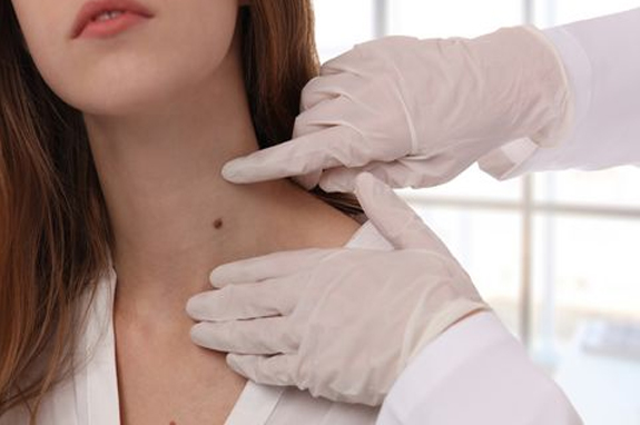 Skin Tags Removal In Gurgaon 