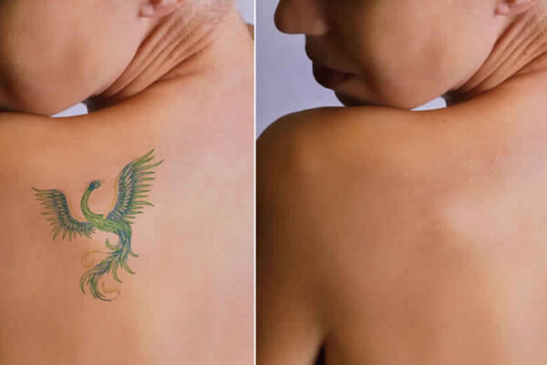 SAFETY MEASURES AND COMPLICATIONS OF LASER TATTOO REMOVAL - IIWAM - CENTRE  OF EXCELLENCE IN AESTHETIC & WELLNESS