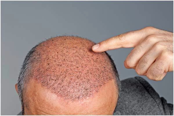 5 Things You Should Avoid After A Hair Transplant Procedure